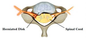 What is a Microdiscectomy?