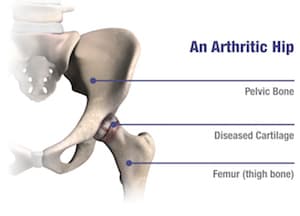 arthritic hip diagram