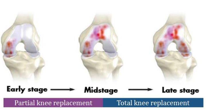 partial knee vs total knee replacement