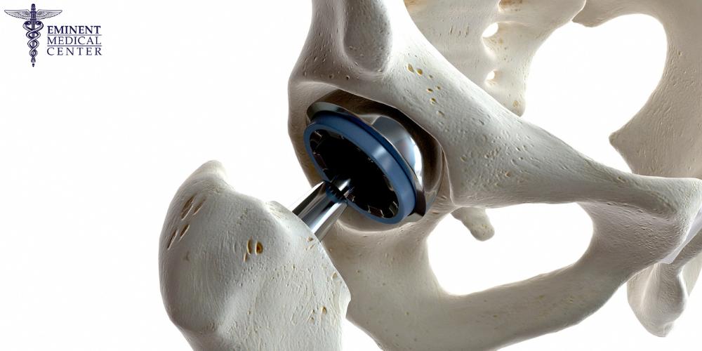 total joint replacements