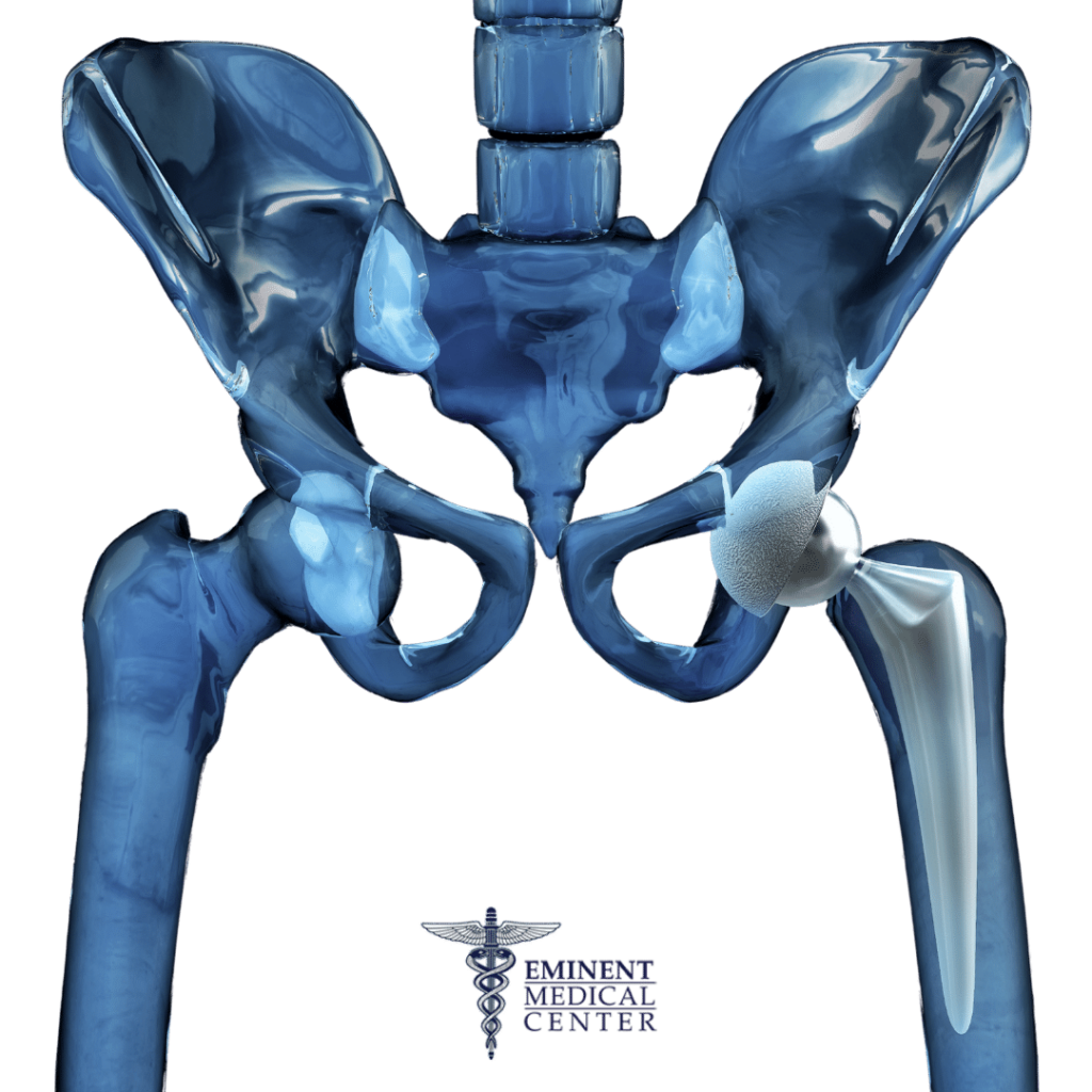 Mako Total Hip Replacement Richardson Tx Eminent Medical