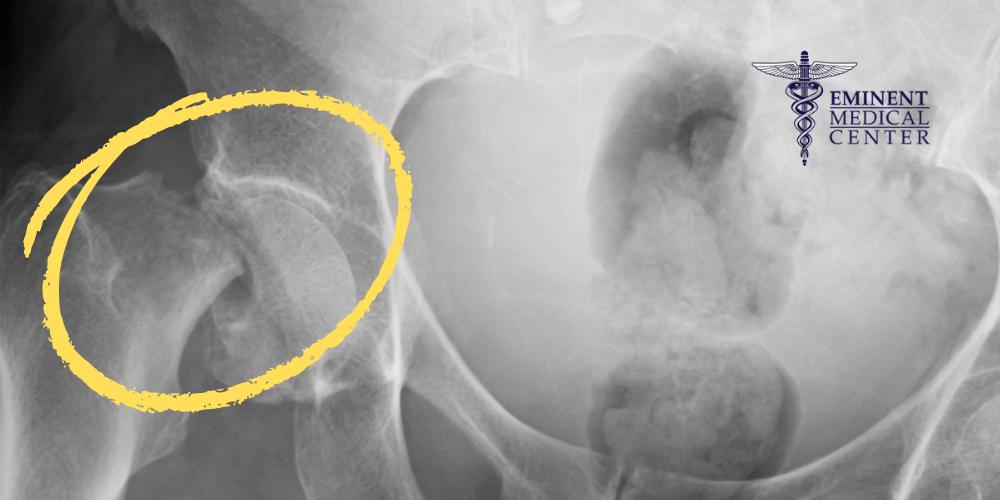 Dallas Hip Fracture Surgery Center