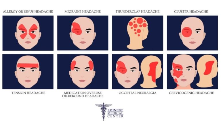 Head Pain Diagram | Types of Headaches and Headache Locations