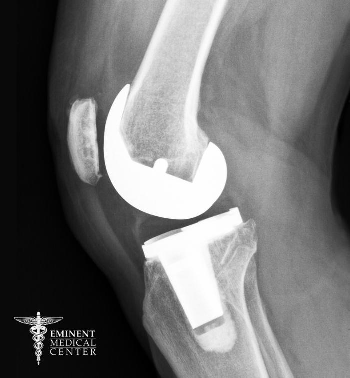 Knee Replacement Surgery Richardson and Dallas, TX