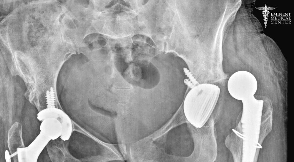 Revision Joint Replacement Surgery Dallas