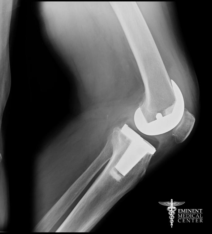 Revision Joint Replacement Surgery Richardson