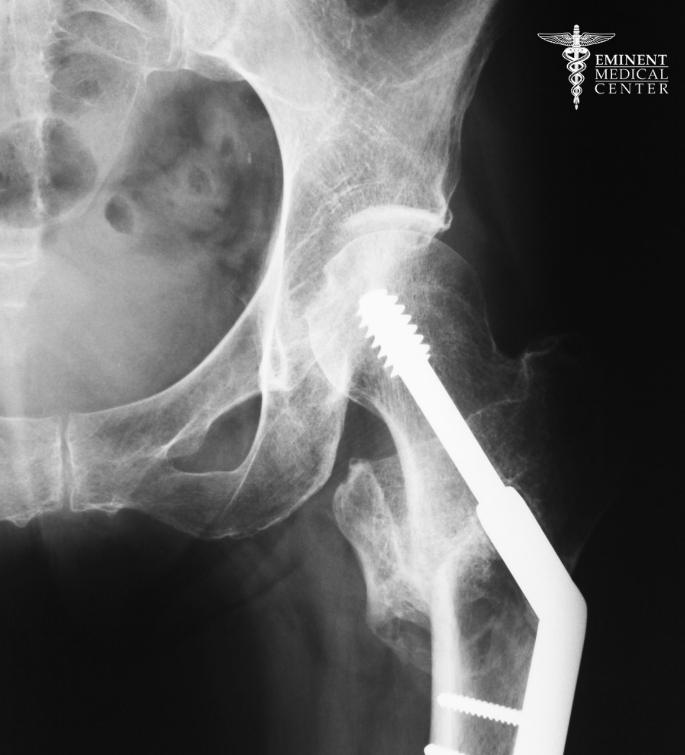 Richardson Hip Fracture Surgery Center