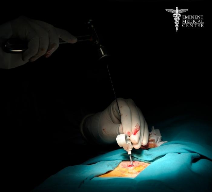 Vertebroplasty Surgery Dallas and Richardson TX