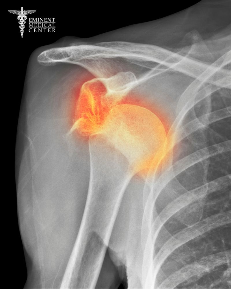 Bankart Repair Surgery in Dallas and Richardson, TX (1)