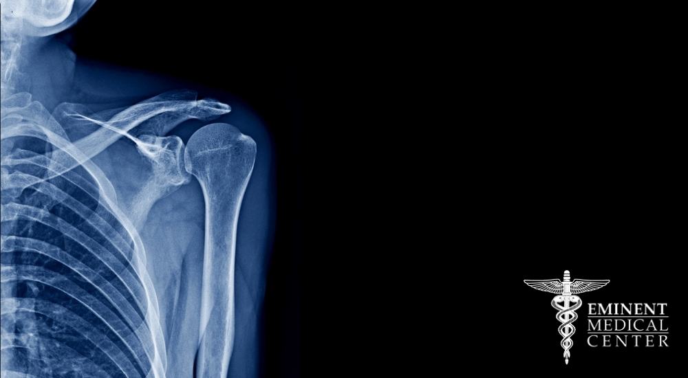 Frozen shoulder surgery Richardson TX