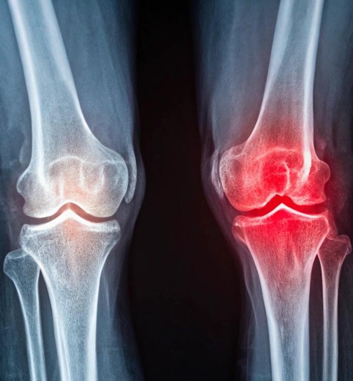 Knee revision replacement surgery in Texas