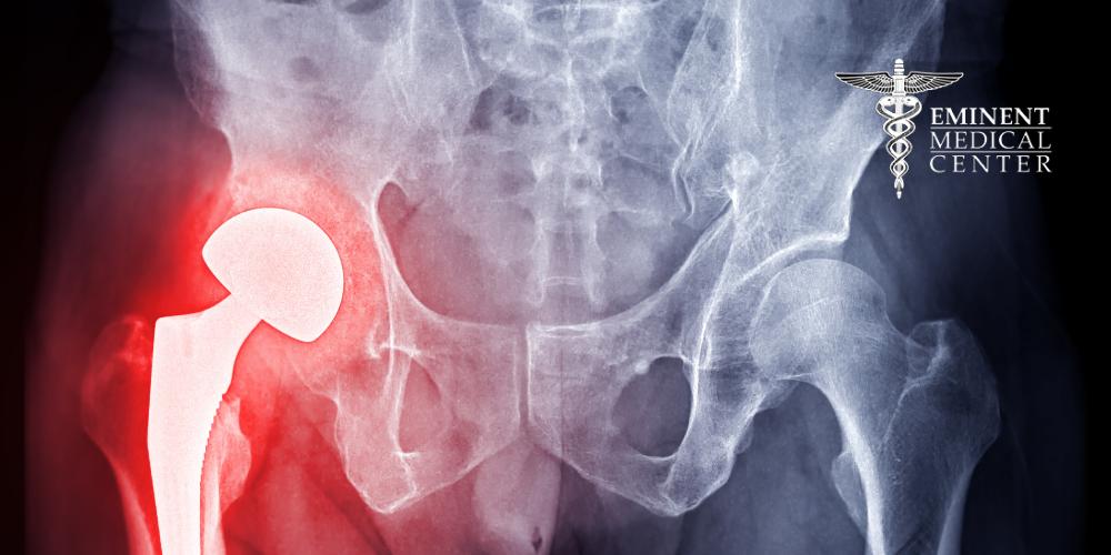 Minimally Invasive Hip Replacement Dallas and Richardson TX