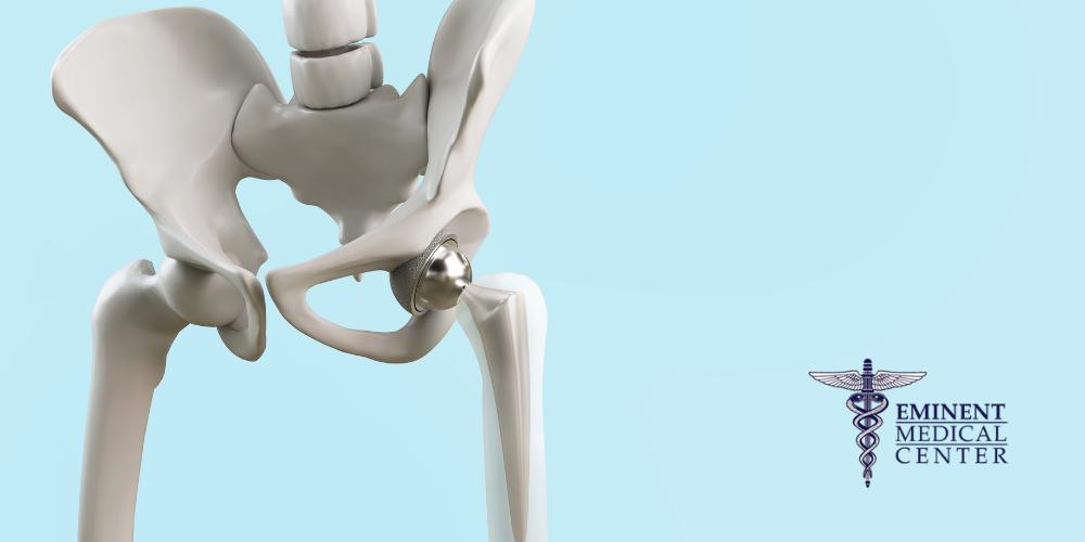 Minimally Invasive Hip Replacement Dallas