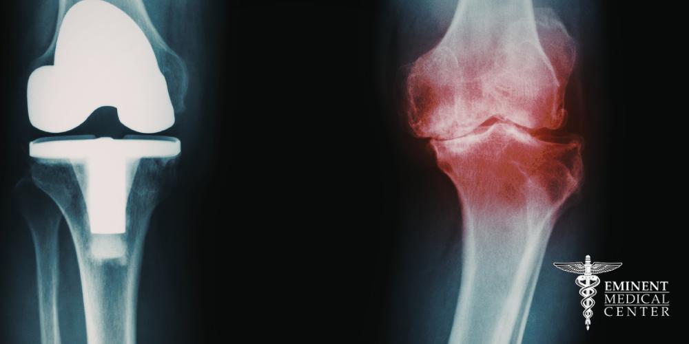 Total Knee Replacement Surgery Dallas and Richardson, TX
