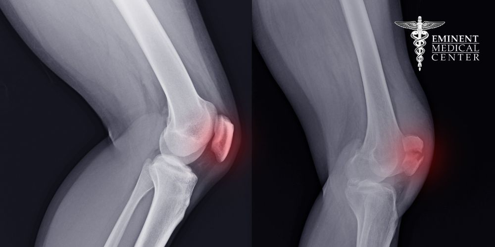kneecap replacement